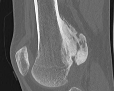 Parosteal Osteosarcoma CT0001